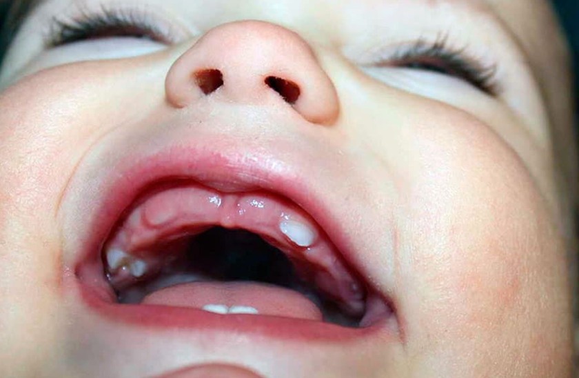 Nướu răng sưng và xuất hiện các đốm trắng