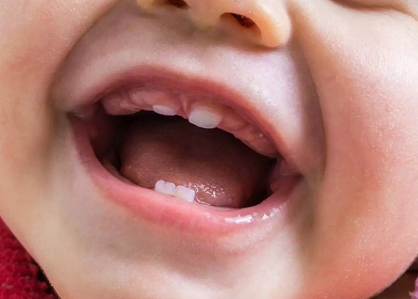 Trẻ chuẩn bị mọc răng sẽ bị sưng nướu răng