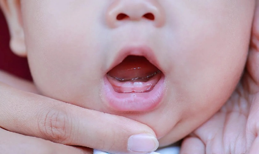 Sưng nướu răng là dấu hiệu bình thường khi trẻ mọc răng