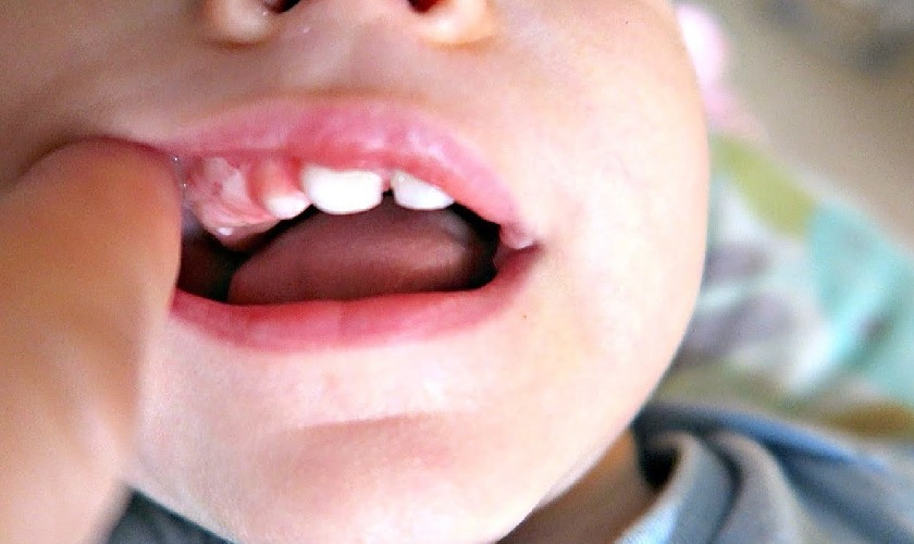 Nướu răng xuất hiện đốm trắng là dấu hiệu cho thấy răng bắt đầu nhú