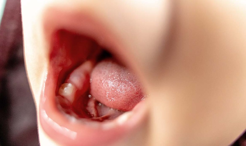 Răng hàm của trẻ đã mọc lên một cái, răng còn lại chuẩn bị mọc và nướu răng tại vị trí đó đang sưng