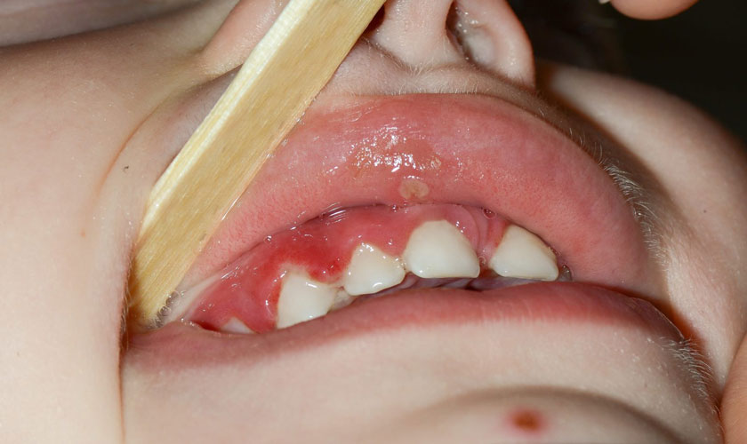 Hình ảnh viêm nướu răng ở trẻ em - Dấu hiệu nhận biết