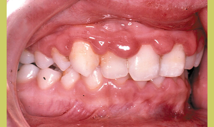 Hình ảnh viêm nướu răng ở trẻ em - Dấu hiệu nhận biết