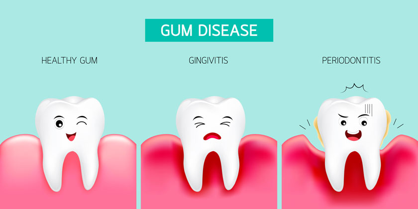 Hình ảnh viêm nướu răng ở trẻ em - Dấu hiệu nhận biết