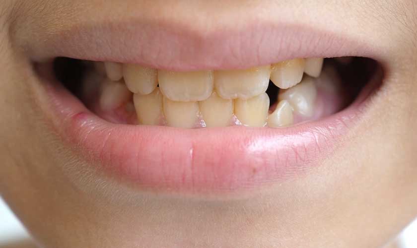 Nguyên nhân răng trẻ em bị vàng và cách điều trị