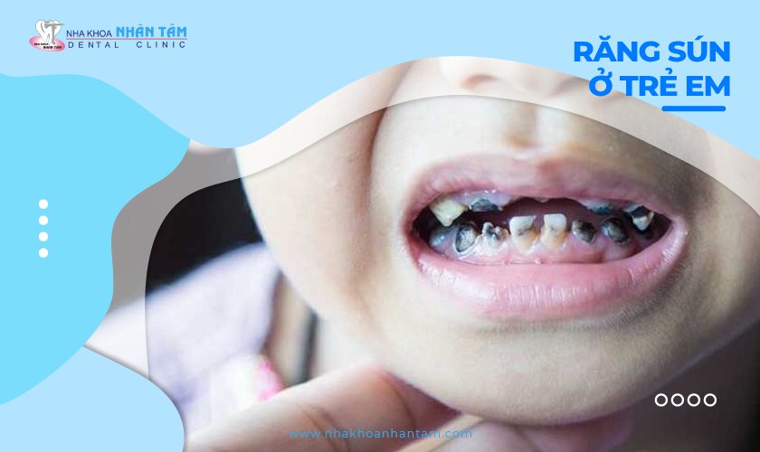 Hình: Răng sún ở trẻ em - Ba mẹ cần làm gì?