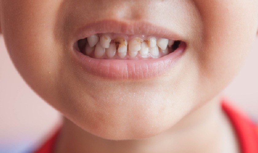 Răng sún thường gặp ở trẻ trong độ tuổi 1 - 3 tuổi