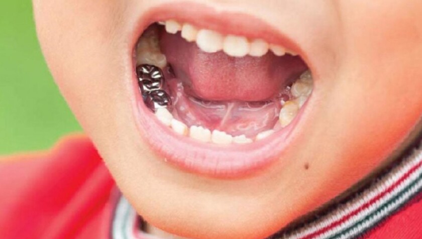 Để bảo tồn những chiếc răng bị sâu nặng, bác sĩ thường chỉ định gắn chụp thép cho trẻ em