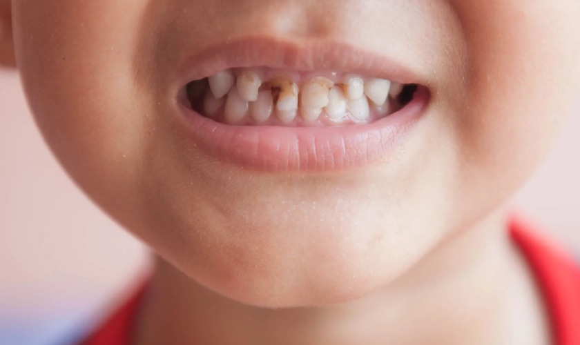 Mòn men răng khiến trẻ bị đau nhức, ê buốt