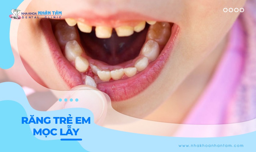Răng trẻ em mọc lẫy: Nguyên nhân và cách xử lý