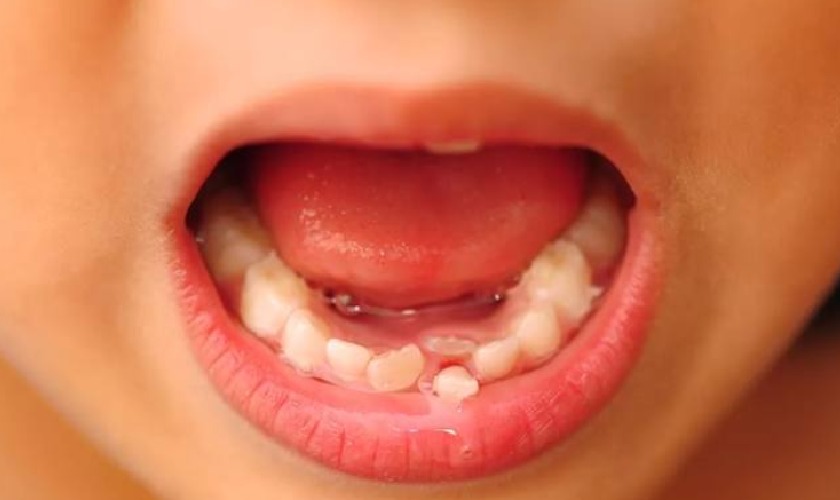 Răng mọc lẫy là tình trạng răng sữa chưa rụng nhưng răng vĩnh viễn đã mọc lên