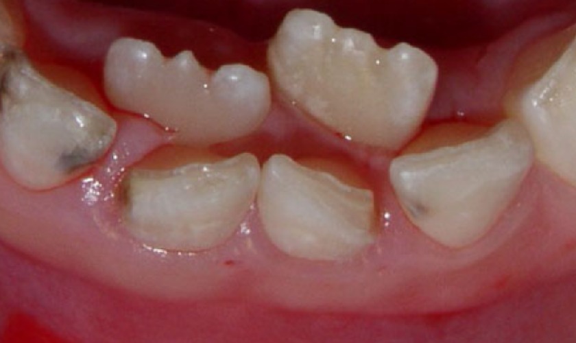 Răng mọc lẫy có thể khiến răng mọc lộn xộn