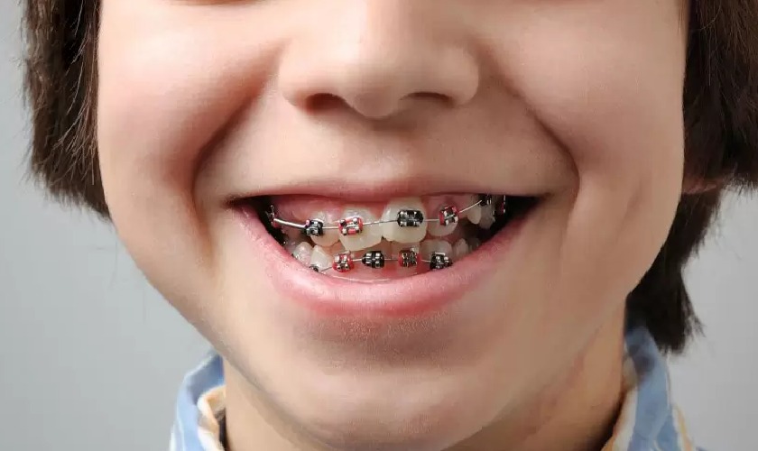 Niềng răng là giải pháp thường được bác sĩ chỉ định để khắc phục tình trạng răng mọc lẫy