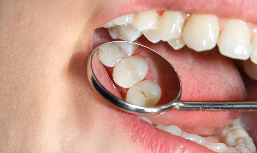 Răng hàm là răng dễ bị sâu do bề mặt nhai có nhiều hố rãnh