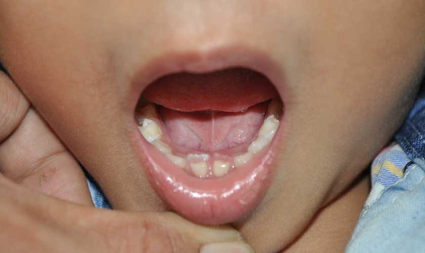 Mất răng sữa sớm hoặc răng sữa không rụng khi răng vĩnh viễn mọc sẽ gây nguy cơ lệch lạc răng Mất răng sữa sớm hoặc răng sữa không rụng khi răng vĩnh viễn mọc sẽ gây nguy cơ lệch lạc răng