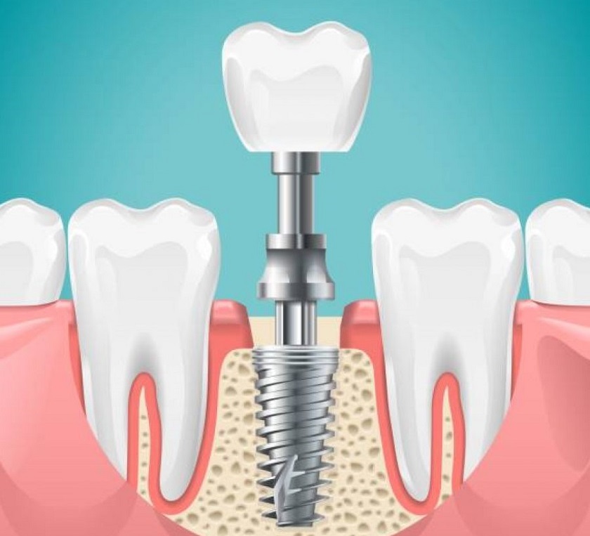 Cắm Implant tức thì sau khi nhổ răng