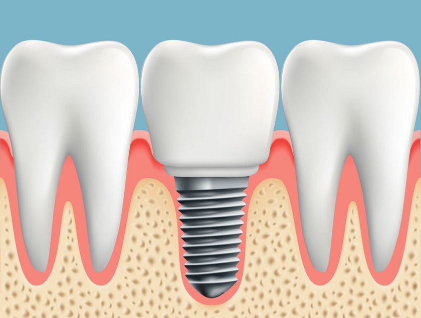 Trồng Implant sau 6 – 12 tháng nhổ răng khi xương hàm đã hoàn toàn hồi phục
