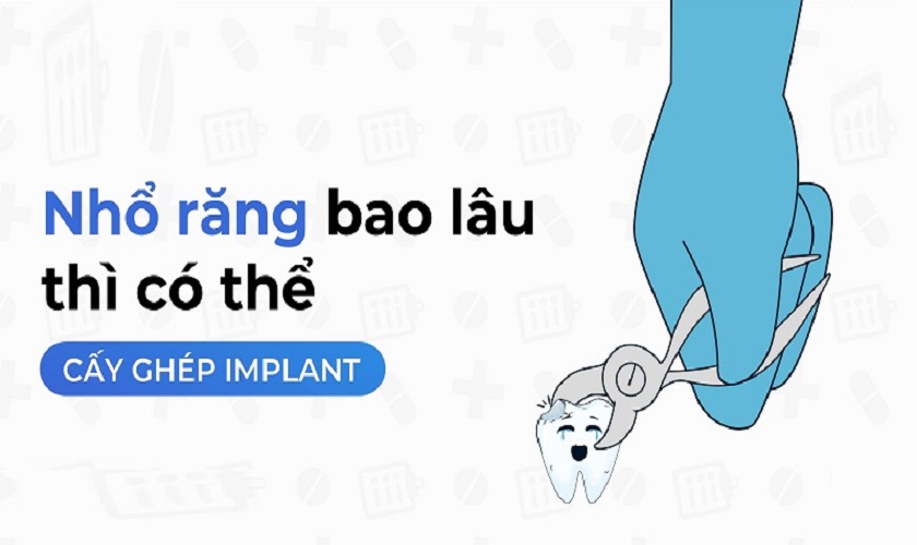 Nhổ răng bao lâu thì trồng Implant được ?