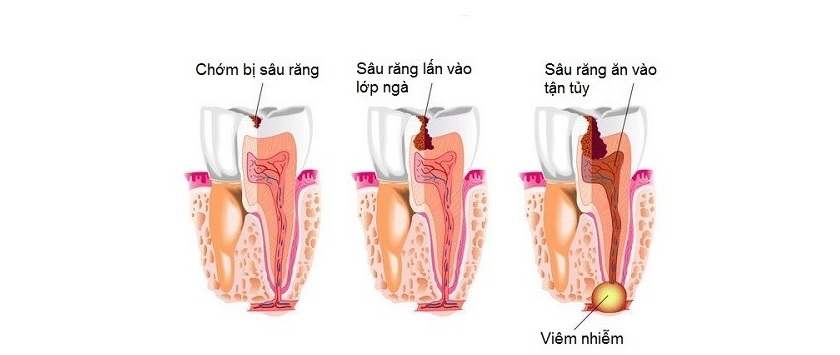 Sâu răng chính là nguyên nhân gây viêm tuỷ