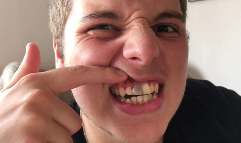 Cách trị răng cửa bị đen bên trong và giữ cho răng luôn trắng