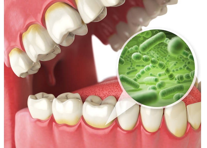 Các giai đoạn của sâu răng là gì?