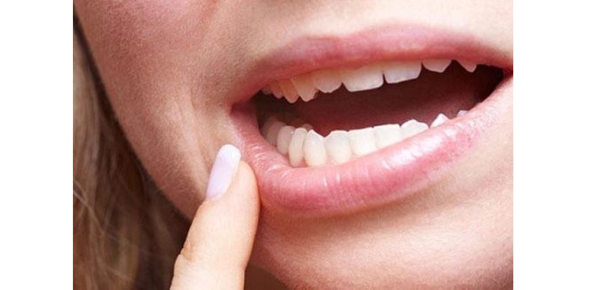 Khi miệng bị khô, vi khuẩn sẽ dễ dàng tấn công hơn, từ đó gây nên tình trạng sâu răng Khi miệng bị khô, vi khuẩn sẽ dễ dàng tấn công hơn, từ đó gây nên tình trạng sâu răng