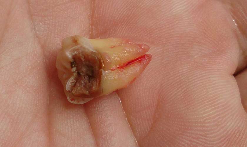 Nhổ răng cấm bị sâu chỉ được chỉ định khi không thể cứu chữa với các kỹ thuật khác