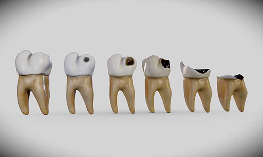 Biểu hiện sâu răng và giải pháp điều trị