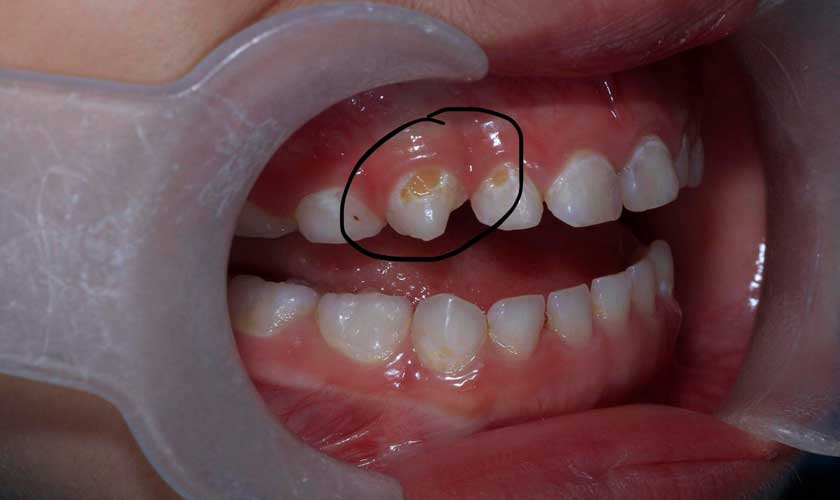 Sâu răng sữa giai đoạn đầu