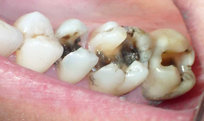 Sâu răng lan vào tủy răng