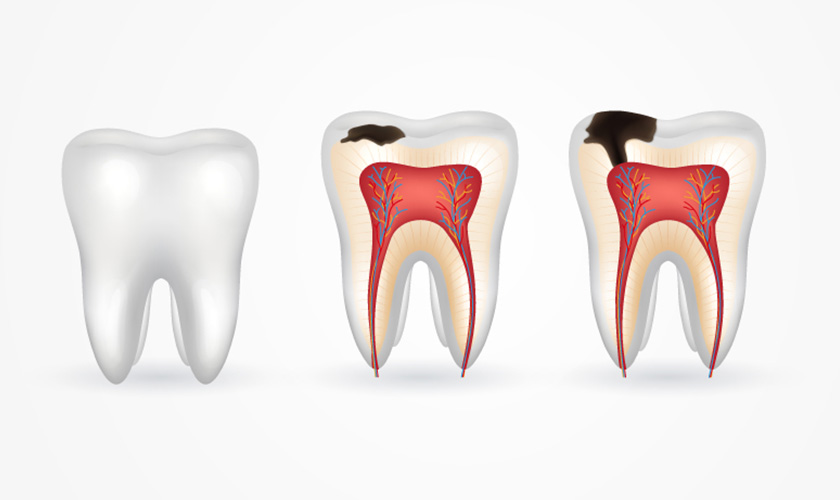 Sâu răng: Các giai đoạn và cách điều trị cho từng trường hợp