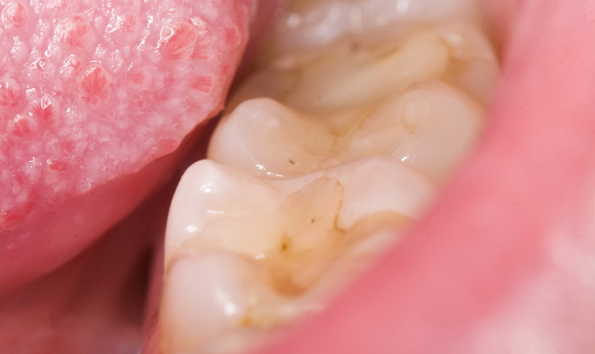 Các giai đoạn sâu răng