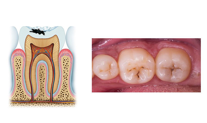 Các giai đoạn sâu răng