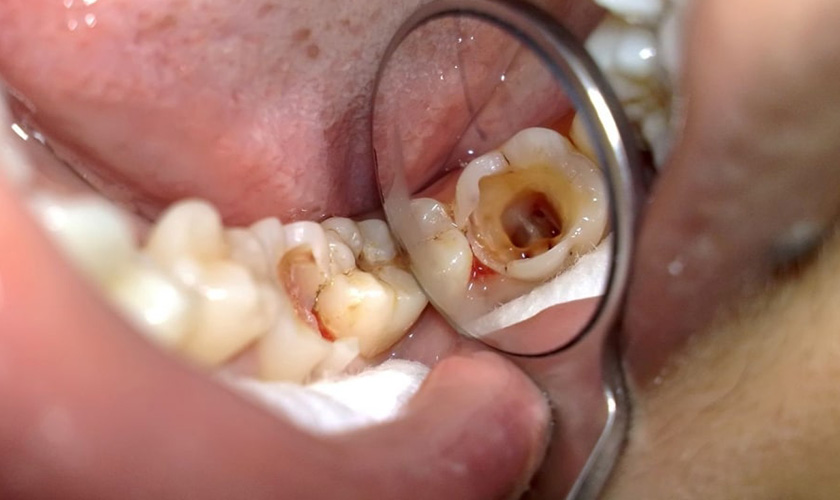 Các giai đoạn sâu răng