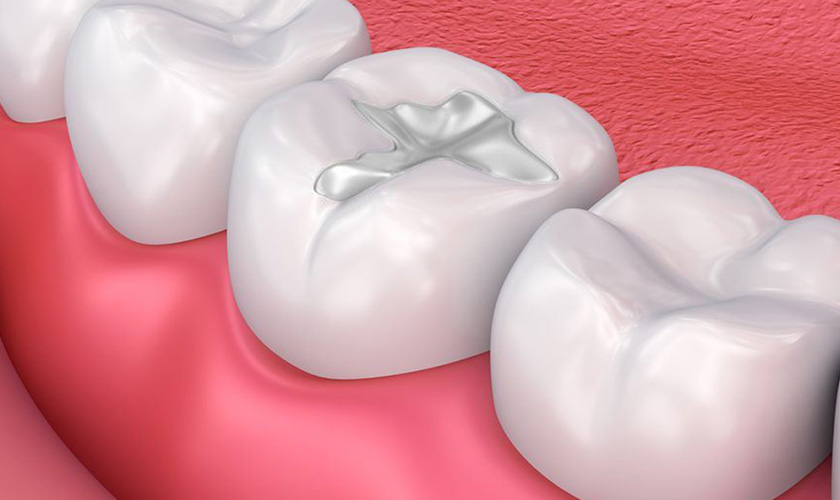 Hàn trám răng bị sâu là cách chữa trị khá hiệu quả Hàn trám răng bị sâu là cách chữa trị khá hiệu quả