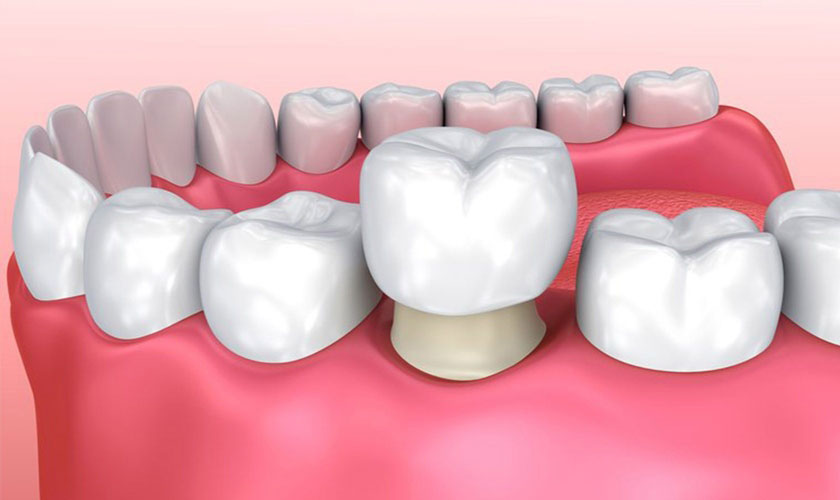 Răng sau khi điều trị tủy nên bọc răng sứ để bảo tồn răng thật Răng sau khi điều trị tủy nên bọc răng sứ để bảo tồn răng thật