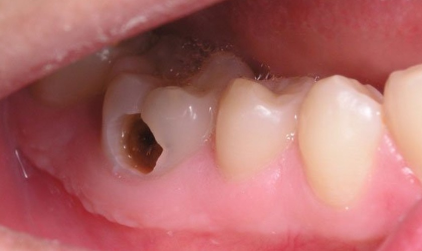 cách trị răng bị lủng lỗ tại nhà
