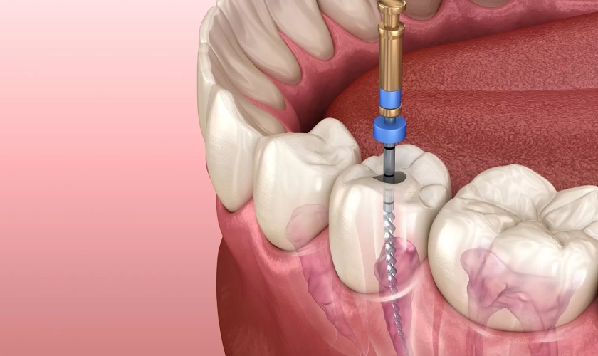 Trường hợp chân răng còn tốt bác sĩ sẽ thực hiện điều trị tủy