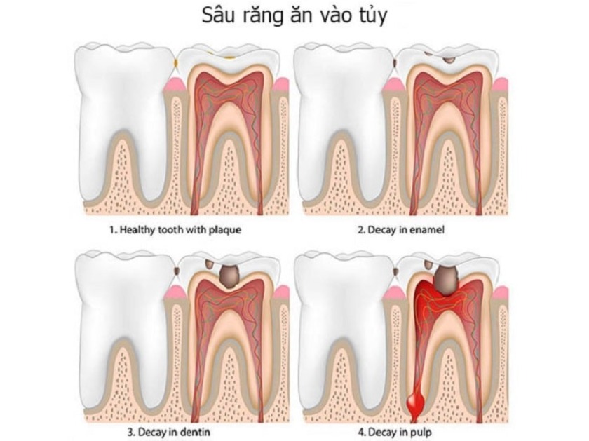 Sâu răng đến tủy nếu không điều trị kịp thời sẽ gây biến chứng nguy hiểm Sâu răng đến tủy nếu không điều trị kịp thời sẽ gây biến chứng nguy hiểm
