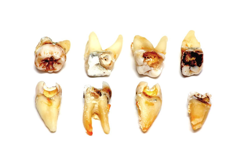 Các giai đoạn sâu răng?