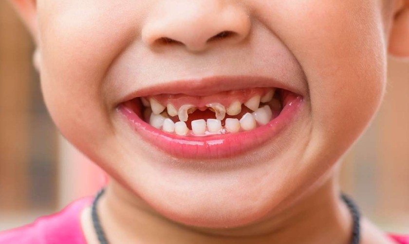 Tình trạng sâu răng ở trẻ