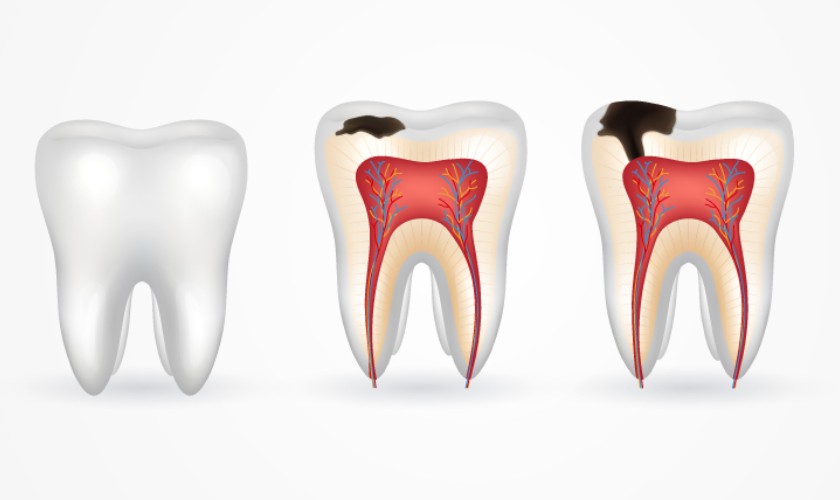 Tiến triển của quá trình sâu răng
