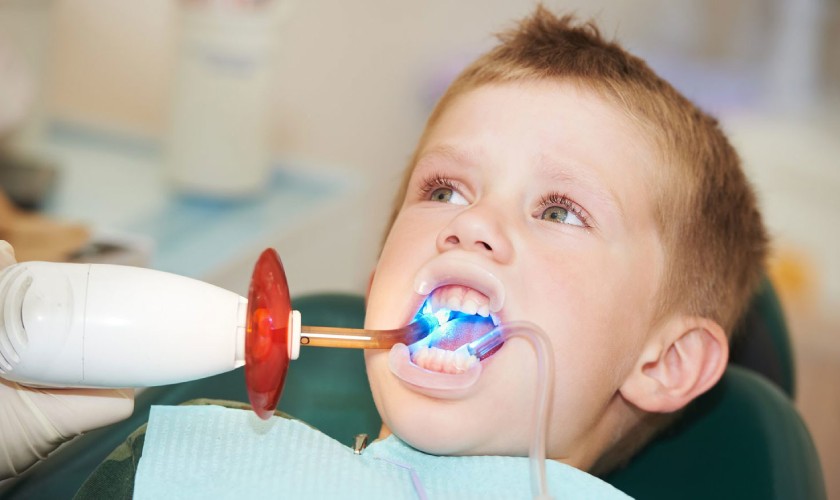 Trám răng điều trị sâu răng ở trẻ