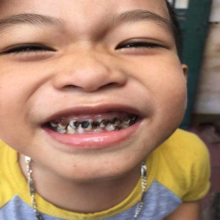 Bị sâu răng cửa nếu không được điều trị sẽ lây lan sang các răng khác