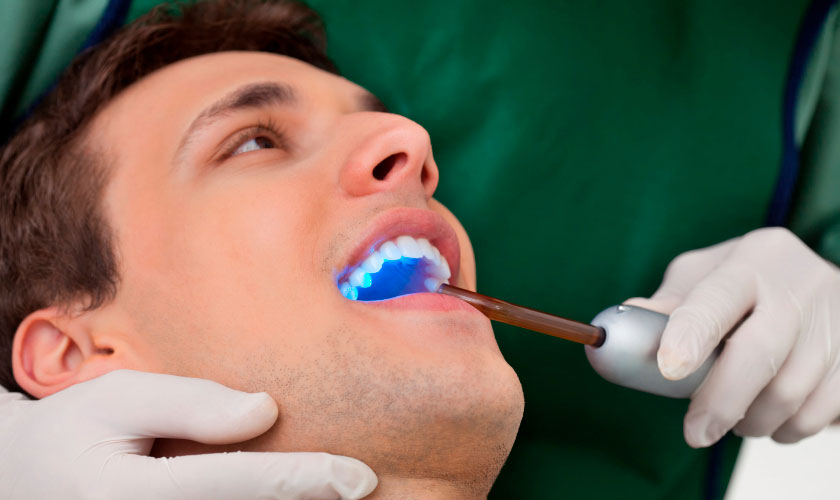 Trám răng thẩm mỹ bằng Laser