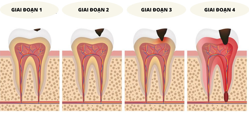 Các giai đoạn tiến triển của bệnh sâu răng