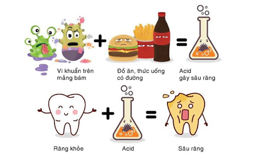 Nguyên nhân gây nên tình trạng sâu răng