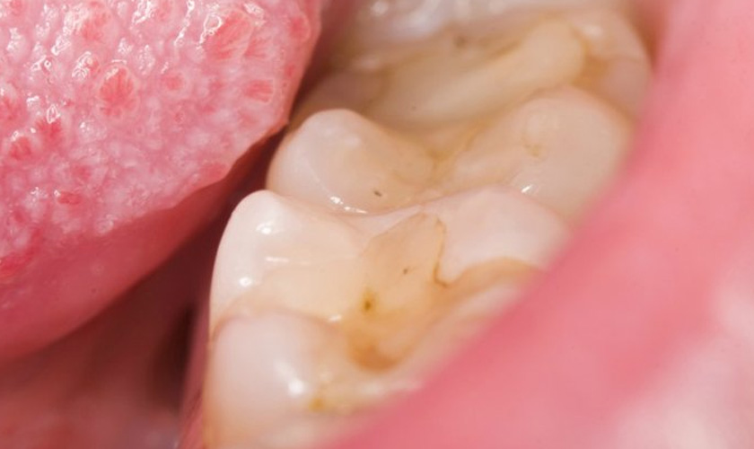 Sâu răng giai đoạn 1