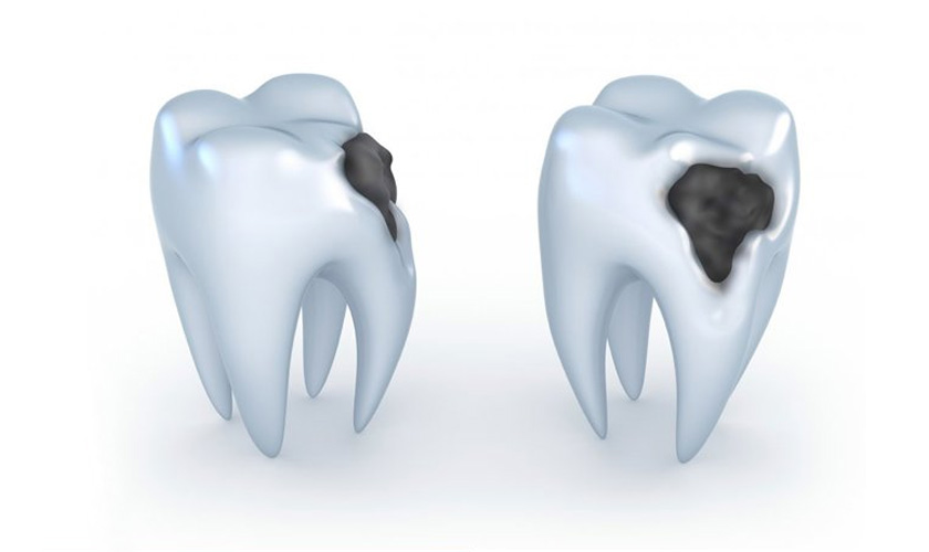 Sâu răng giai đoạn 2