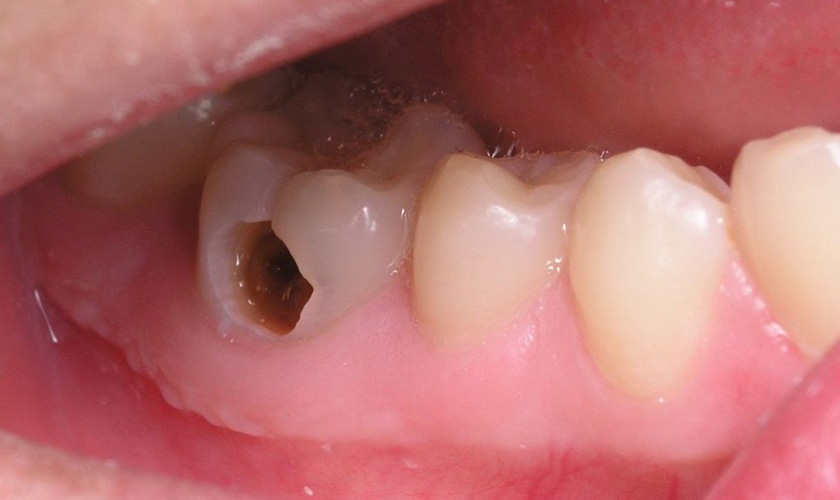 Sâu răng giai đoạn 3